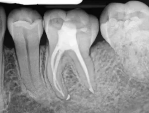 Radioscope image of a root canal after treatment