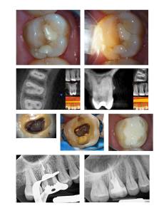 Several digital images showing before, during, and after a root canal procedure